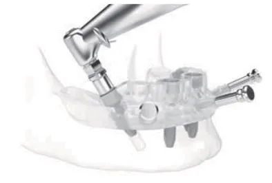 オペ時間・治療期間の短縮